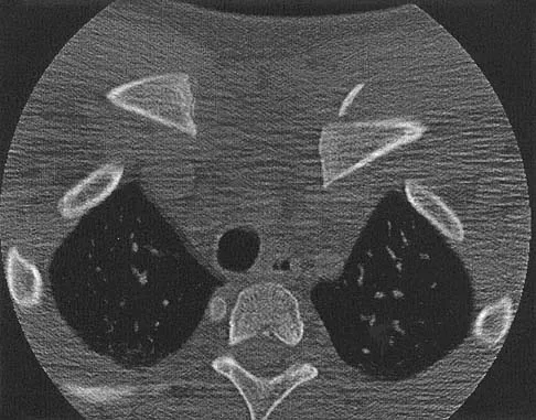 Upper Extremity Board Review 2005: High-Yield MCQs (Set 2) - Figure 32