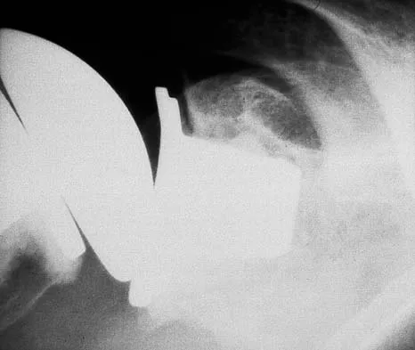 Upper Extremity Board Review 2005: High-Yield MCQs (Set 2) - Figure 5