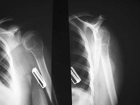 Click to enlarge Upper Extremity 2005 Practice Questions: Set 3 (Solved) - Figure 13
