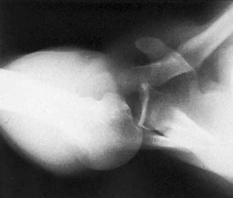 Upper Extremity Board Review 2005: High-Yield MCQs (Set 4) - Figure 16