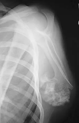 Upper Extremity Board Review 2005: High-Yield MCQs (Set 4) - Figure 6