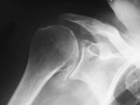 Upper Extremity Orthopedic MCQs (Set 1): Shoulder, Elbow, Hand & Wrist | AAOS/ABOS Exam Prep