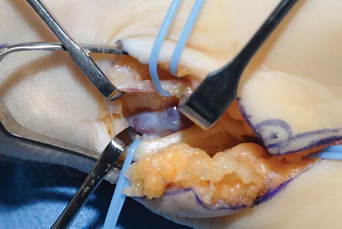 Orthopedic Board Review 2026: 100 High-Yield MCQs & Answers