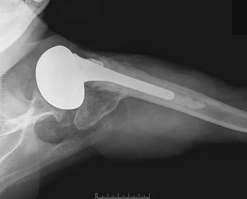 Upper Extremity 2008 Practice Questions: Set 1 (Solved) - Figure 4