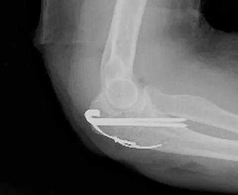 Upper Extremity Board Review 2008: High-Yield MCQs (Set 2) - Figure 1