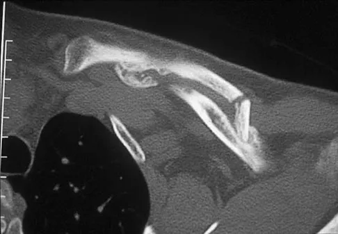 Upper Extremity Board Review 2008: High-Yield MCQs (Set 2) - Figure 17
