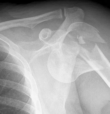 Upper Extremity Board Review 2008: High-Yield MCQs (Set 2) - Figure 20