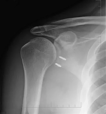 Upper Extremity Board Review 2008: High-Yield MCQs (Set 2) - Figure 26