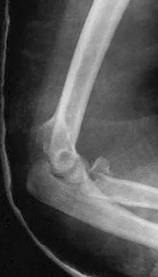 Upper Extremity Board Review 2008: High-Yield MCQs (Set 2) - Figure 3