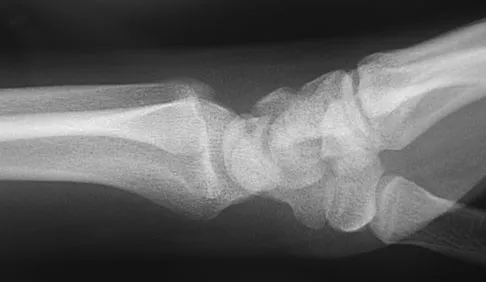 Upper Extremity Board Review 2008: High-Yield MCQs (Set 2) - Figure 30