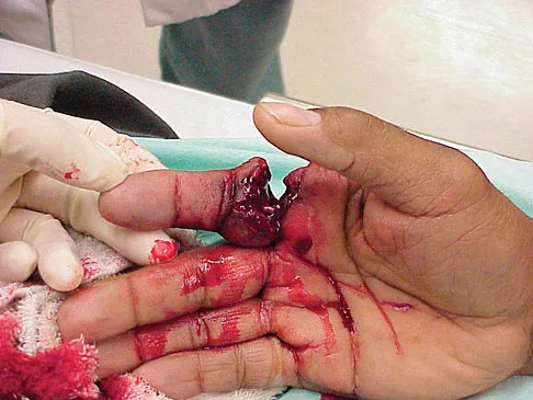 Upper Extremity Board Review 2008: High-Yield MCQs (Set 4) - Figure 14