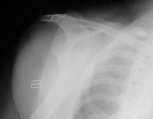 AAOS Upper Extremity MCQs (Set 5): Shoulder, Elbow & Wrist Injuries | ABOS Review