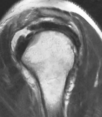 AAOS Orthopedic Upper Extremity MCQs (Part 1): Shoulder & Elbow Trauma | 2026 Board Review