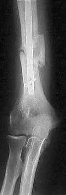 Upper Extremity 2026 MCQs: Board Review Questions & Answers (Part 1) - Figure 43