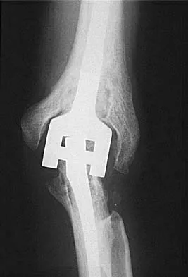 Upper Extremity 2026 MCQs: Board Review Questions & Answers (Part 1) - Figure 47