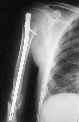 AAOS Orthopedic Upper Extremity MCQs (Part 2): Elbow, Wrist & Hand | 2026 Board Prep