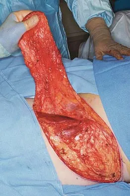 Orthopedic Upper Extremity MCQs (Part 3): Shoulder, Elbow, & Wrist Trauma for AAOS/ABOS Boards