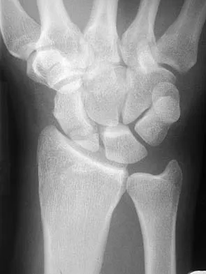 Orthopedic Upper Extremity MCQs (Part 5): Shoulder, Elbow, Wrist & Hand | ABOS 2026 Review