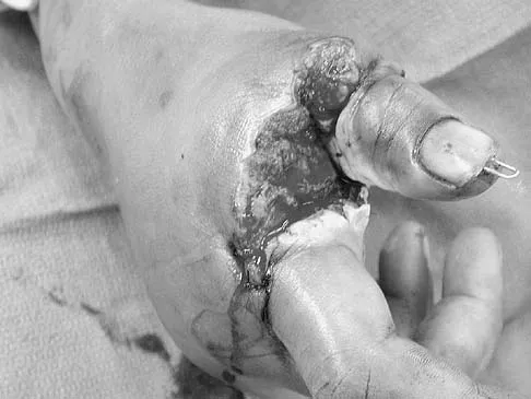 Upper Extremity 2026 MCQs: Board Review Questions & Answers (Part 5) - Figure 33