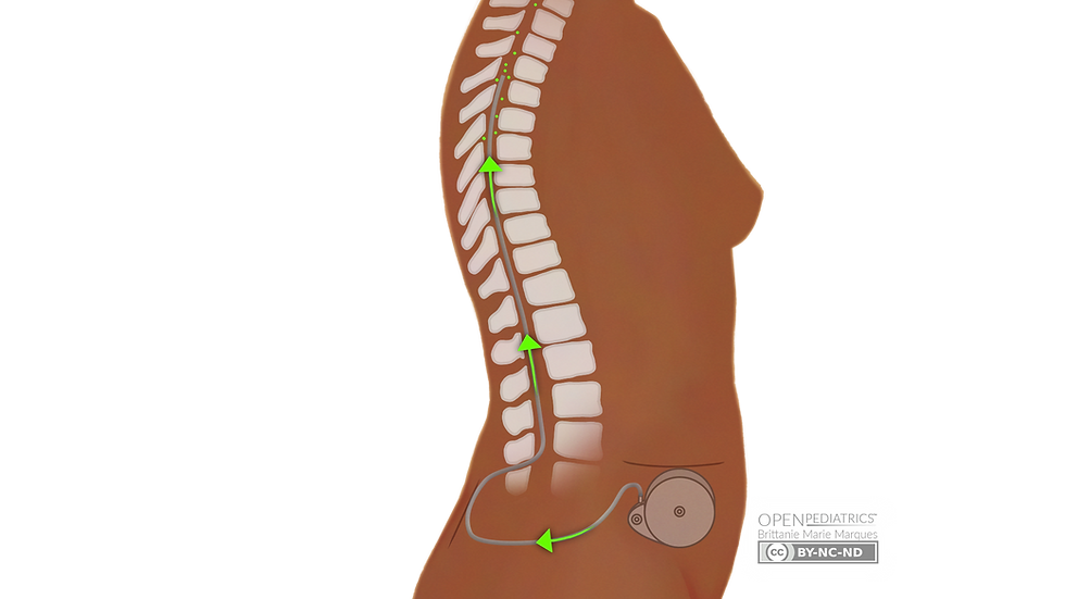 Image of Baclofen Pump Refill