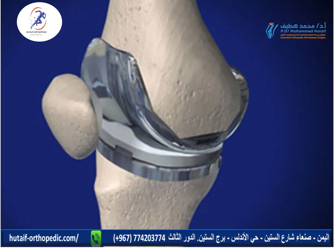 صورة توضيحية حول تغيير مفصل الركبة في اليمن - د. محمد هطيف