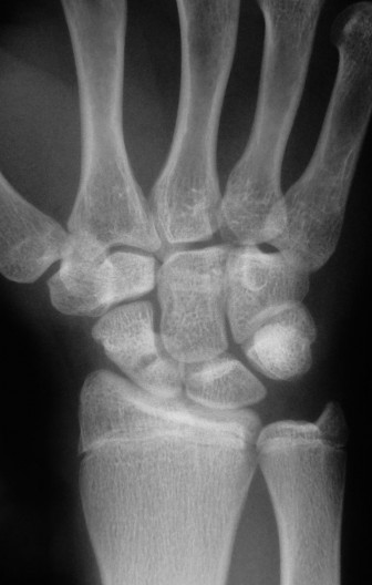 Illustration 2 for Christine M Kleinert Discussion: Solving Difficult Wrist Fractures