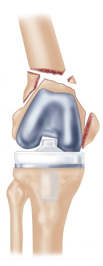 Illustration 3 for Structural Allografting Figure Guide: Solutions for Bone Deficiency