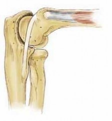 Illustration 11 for Precision Arthroscopy for Chondral Injuries & OCD: Direct Lateral Portal