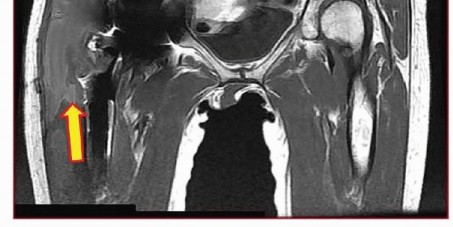 Illustration 20 for Which Bearing Surface Options Are Best for Your Total Hip?