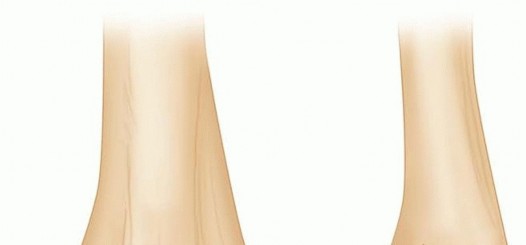 Navigating Capitellum and Capitellar-Trochlear Shear Fracture Repair