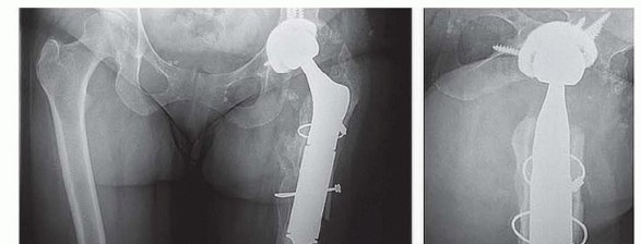 Illustration 2 for Limb Salvage: New Advances in Proximal Femoral Replacement