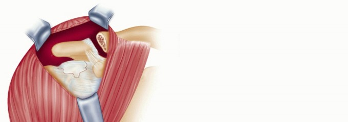 Illustration 11 for Subscapularis & Teres Rotator Cuff Repair: Advanced Techniques