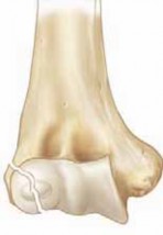 Lateral Condyle Fractures: Optimize ORIF to Prevent Tardy Ulnar Nerve