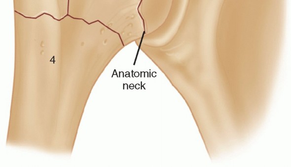 Illustration 2 for Hemiarthroplasty for Proximal: Effective Treatment for Fractures