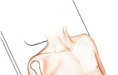 Illustration 86 for Mastering Elbow Approaches: Applied Surgical Anatomy for Precision