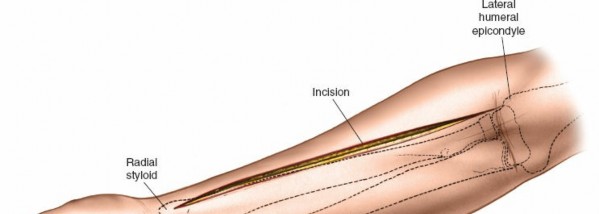 Illustration 87 for Mastering Approaches to the Upper Third of the Radius
