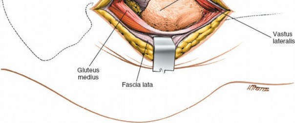 Illustration 139 for Unlocking Every Aspect of the Hip's Surgical Approaches