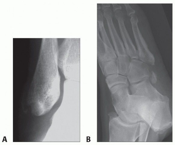 Peroneus Brevis Tendon Tear: Early Repair for Full Recovery