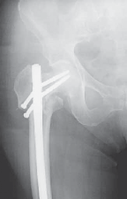Illustration 16 for Advanced Arthroplasty for Malignant Lesions: Reclaim Your Mobility