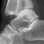 Illustration 4 for Decoding Pilon Fractures: Anterolateral and Medial Fragments Revealed