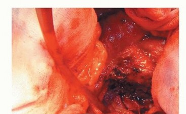 Illustration 47 for Hemiarthroplasty of the Hip: Indications & Types Explained