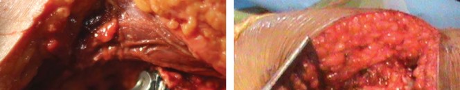 Illustration 9 for Considering METHA Short Stem? Discover Bone-Preserving THA