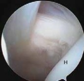 Illustration 12 for Arthroscopic Subscapularis Repair: The lo iky brady Method for Stability