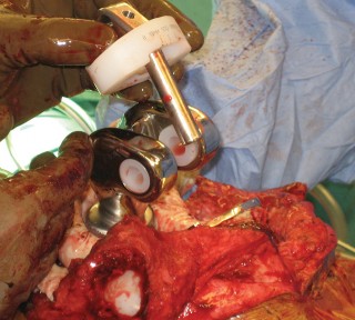 Illustration 53 for Hinged Total Knee: The Salvage Solution for Challenging Cases