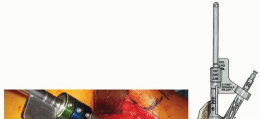 Illustration 18 for Recreate Hip Biomechanics: Modular Stems for Modular Solutions