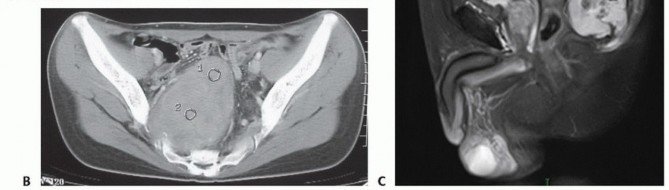 Illustration 19 for Sacral Tumor Surgery: Safeguarding Bowel & Bladder Control