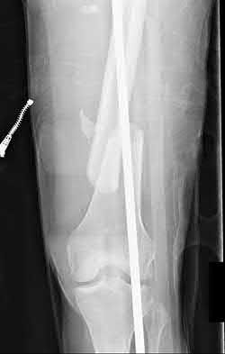 Illustration 130 for OrthoCash: Trauma MCQs & Cases for a yearold woman