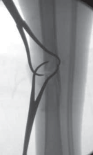 Illustration 41 for Optimal Nailing of the Tibia: Techniques for Challenging Fractures