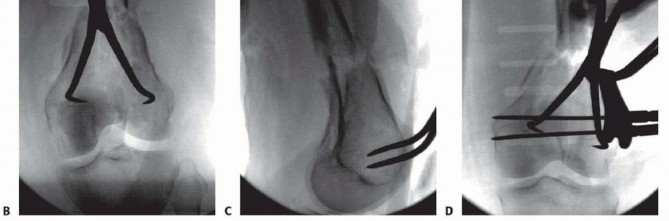Illustration 48 for Repairing Distal Femur Fractures: Open Reduction & Internal Fixation