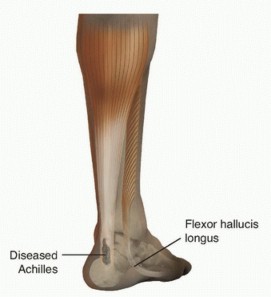 FHL Transfer for Achilles Tendinosis: End Your Pain